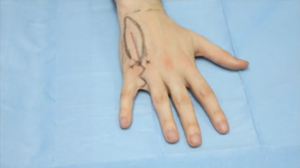 Fourth space Dorsal metacarpal reverse flap