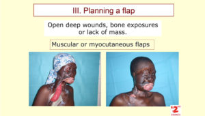 introduction-to-flap-surgery_II_2