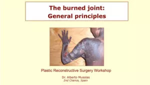 108 - The burned joint: General prinicples - Dr. Alberto MUSOLAS