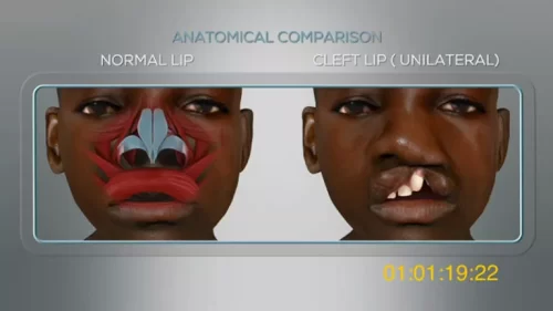 2C-3D Unilateral cleft lip – Video HD complete