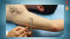 Posterior arm flap