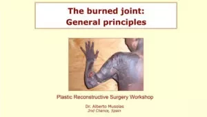 108 - The burned joint: General prinicples - Dr. Alberto MUSOLAS