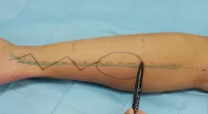 Distally based Sural artery neurocutaneous flap