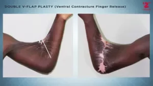 Double V-Flap Plasty