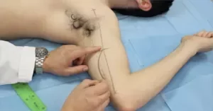 Brachial Medial arm flap