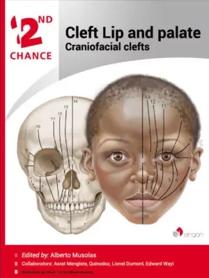 Cleft Lip and palate | Craniofacial clefts