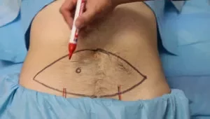 Deep inferior epigastric perforator flap (DIEP)