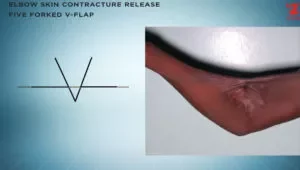 Elbow Skin Contracture – 5 Forked V Flap