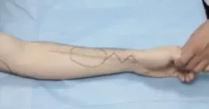 Forearm radial artery flap