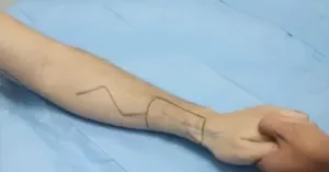 Proximally based radial artery perforator flap