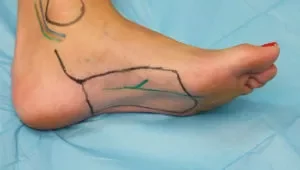 Medial planter flap