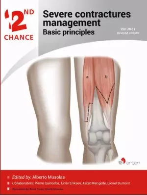 Severe Contractures Management | Basic principles