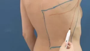 Latissimus Dorsi myocutaneous flap