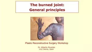 108 - The burned joint: General prinicples - Dr. Alberto MUSOLAS