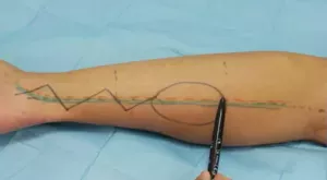 Distally based Sural artery neurocutaneous flap