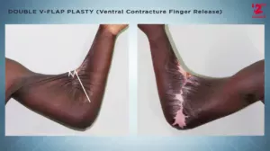 Double V-Flap Plasty