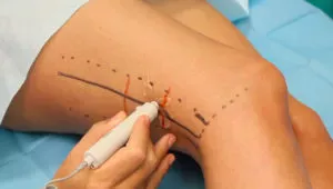 Biceps femoris perforator flap (Lateral-distal thigh flap)