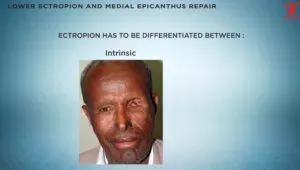 Lower Ectropion and Medial Epicanthus Repair