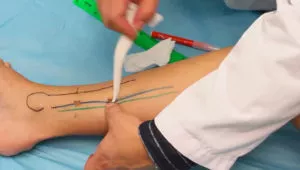 Posterior tibial perforator flap