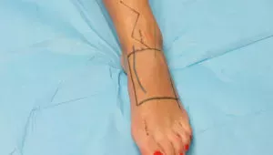 Dorsalis pedis cutaneous flap