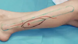 Peroneal artery perforator flap