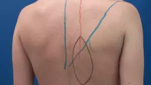 Trapezius muscle and myocutaneous flap